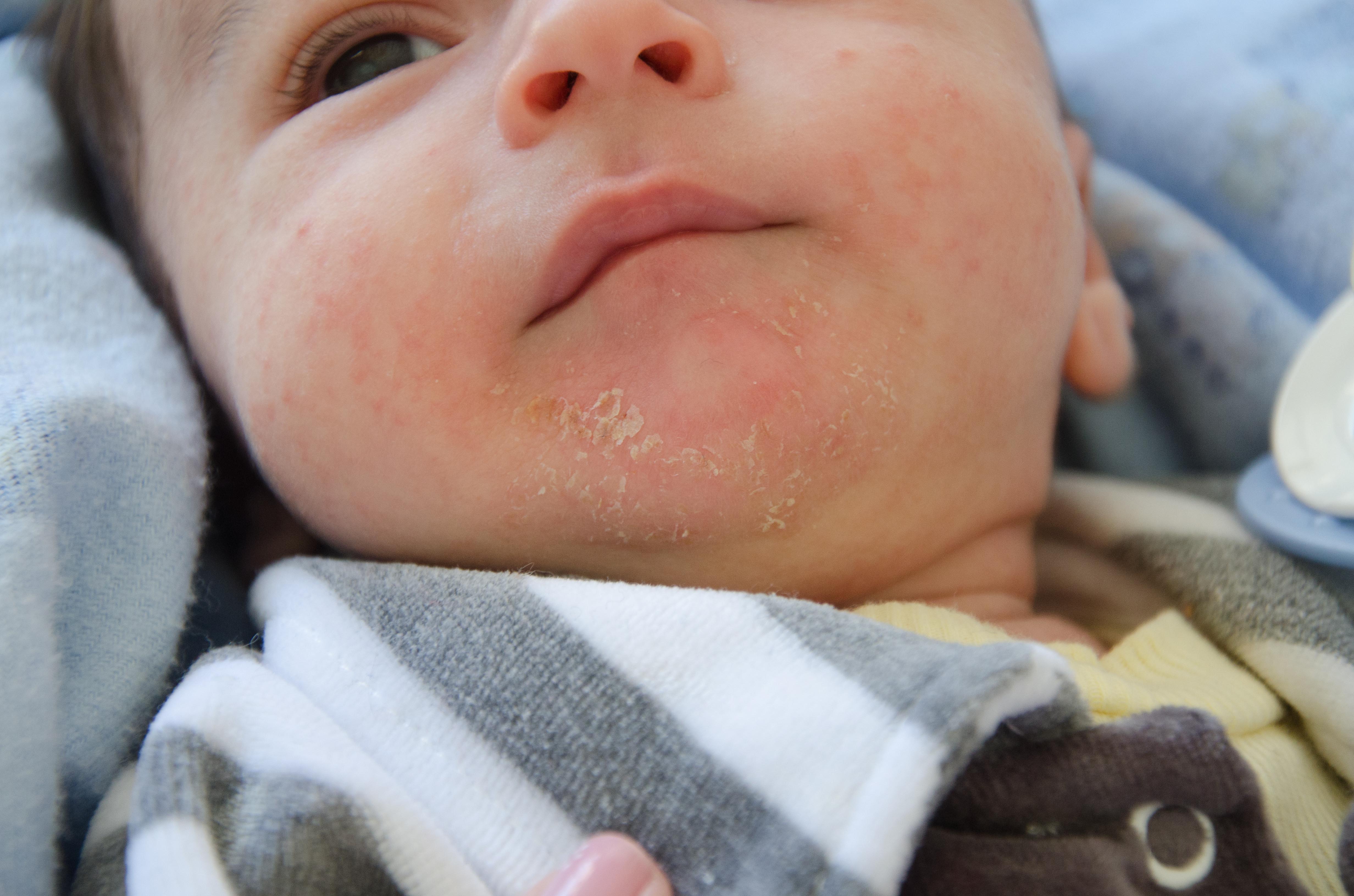 Dermatite atópica em bebês: quais são os cuidados? - Just Real Moms
