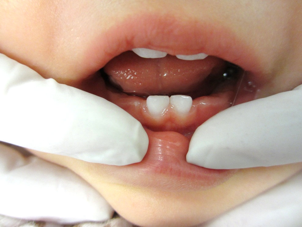 dentes 1