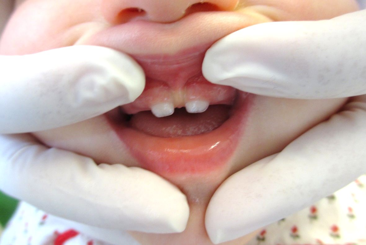 dentes 2