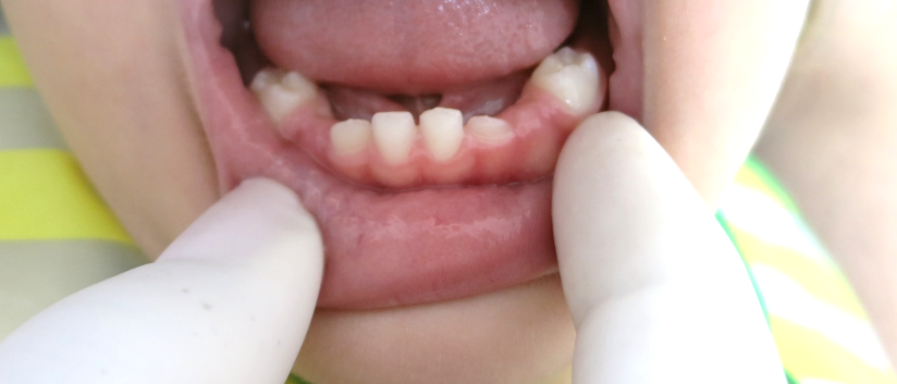 dentes 3