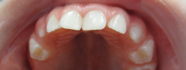 dentes 8