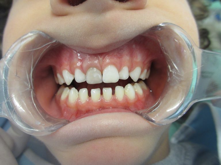 Seu filho caiu, bateu a boca e o dente escureceu? E agora? – por Dra. Lúcia Coutinho