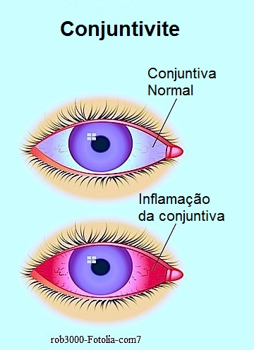 Saiba tudo sobre o surto de conjuntivite! - por Dr. Jairo Len - Just Real Moms