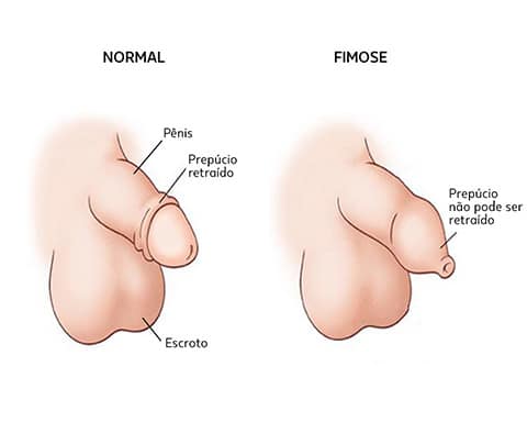Just Real Moms Doenças Infantis Urologicas Dr Rafael Rocha FImose