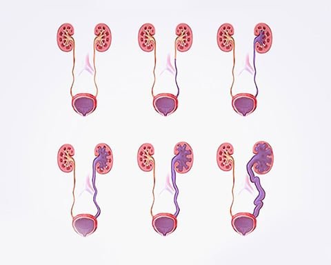 Just Real Moms Doenças Infantis Urologicas Dr Rafael Rocha Refluxo Vesicoureteral