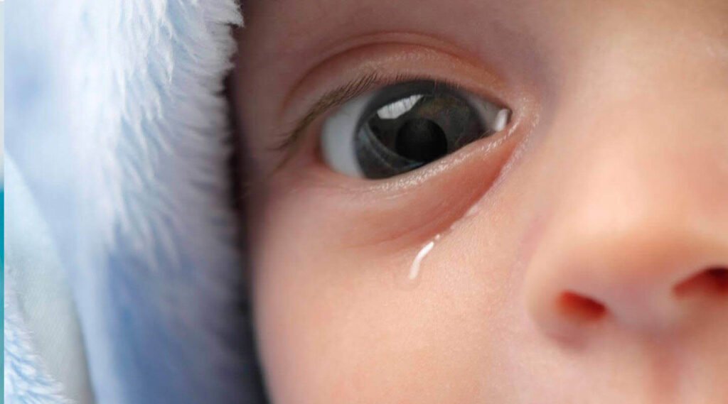 Just Real Moms Obstrução Congenita do canal lacrimal Bebe