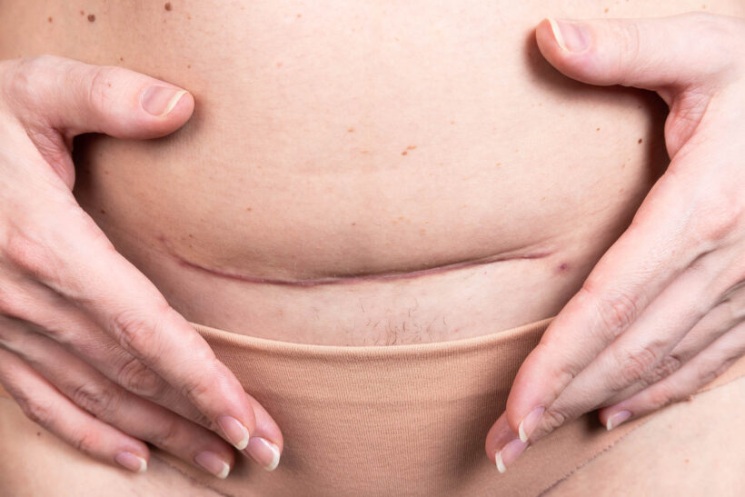 Cicatriz da Cesárea Funda Porque Um Problema Sem Solução Dra Larissa Sumodjo Just Real Moms