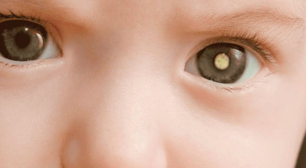 Retinoblastoma Cancer Olhos Infantil Tiago Leifert Daiana Garbin Just Real Moms Crédito Departamento de Oncologia e Hematologia da SGP