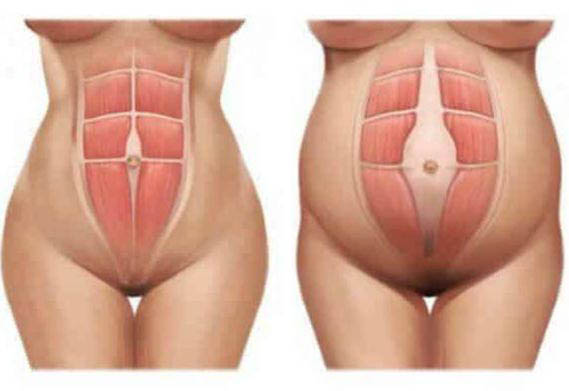 Tratamento diástase de reto abdominal Dra Larissa Sumodjo Just Real Moms