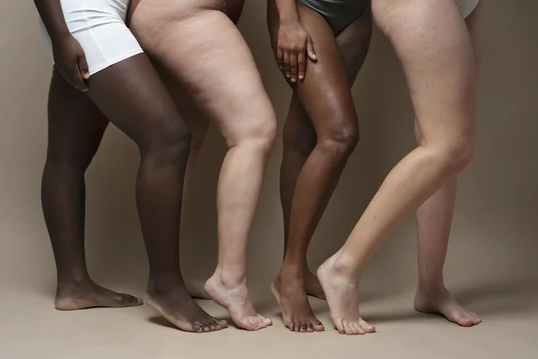6 sinais de que você pode ter Lipedema
